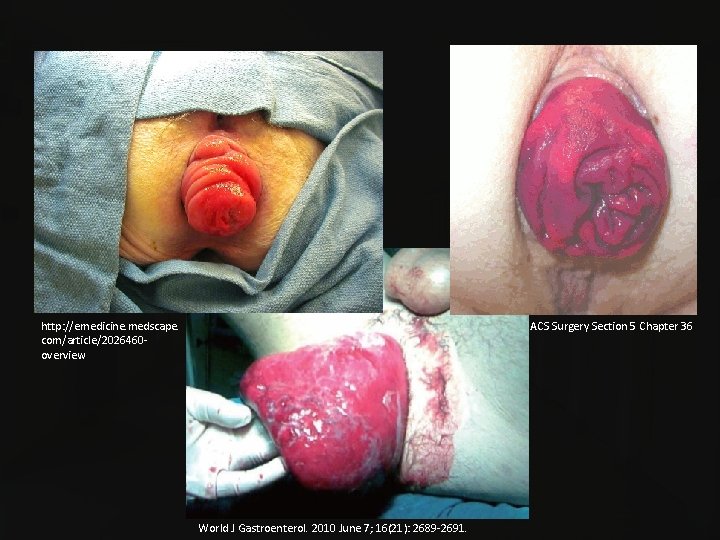 http: //emedicine. medscape. com/article/2026460 overview ACS Surgery Section 5 Chapter 36 World J Gastroenterol.