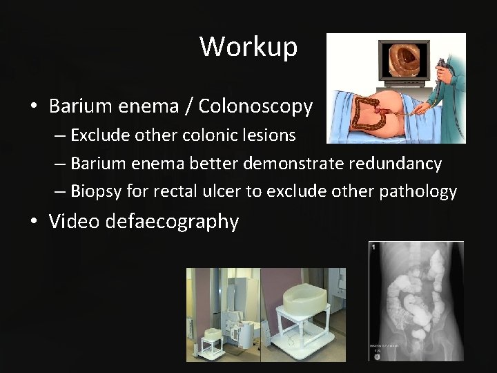 Workup • Barium enema / Colonoscopy – Exclude other colonic lesions – Barium enema