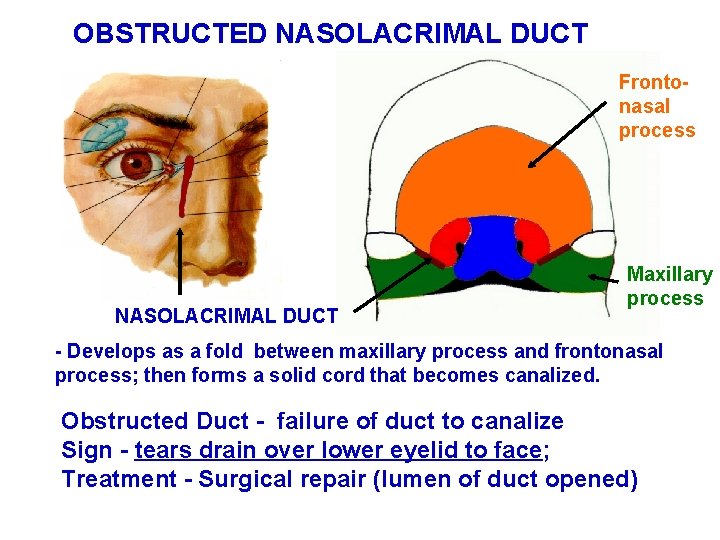 OBSTRUCTED NASOLACRIMAL DUCT Frontonasal process NASOLACRIMAL DUCT Maxillary process - Develops as a fold