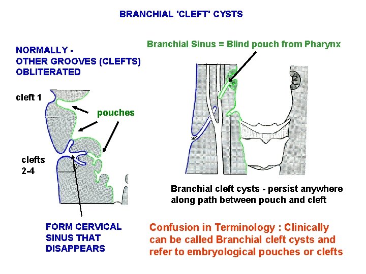 BRANCHIAL 'CLEFT' CYSTS NORMALLY OTHER GROOVES (CLEFTS) OBLITERATED Branchial Sinus = Blind pouch from BRANCHIAL 'CLEFT' CYSTS NORMALLY OTHER GROOVES (CLEFTS) OBLITERATED Branchial Sinus = Blind pouch from