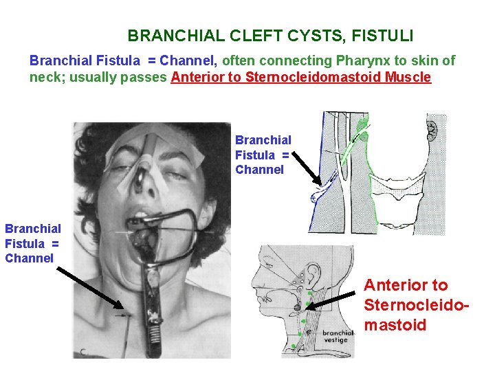 BRANCHIAL CLEFT CYSTS, FISTULI Branchial Fistula = Channel, often connecting Pharynx to skin of