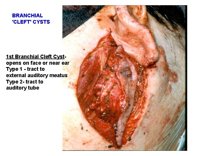 BRANCHIAL 'CLEFT' CYSTS 1 st Branchial Cleft Cystopens on face or near Type 1 BRANCHIAL 'CLEFT' CYSTS 1 st Branchial Cleft Cystopens on face or near Type 1