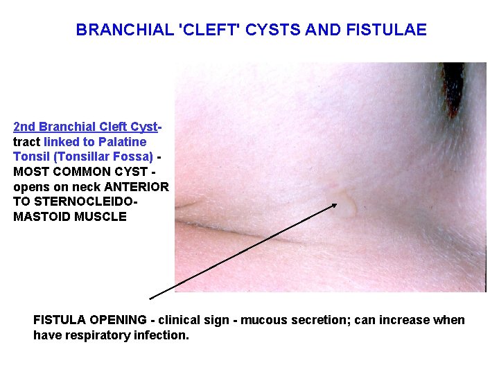 BRANCHIAL 'CLEFT' CYSTS AND FISTULAE 2 nd Branchial Cleft Cysttract linked to Palatine Tonsil