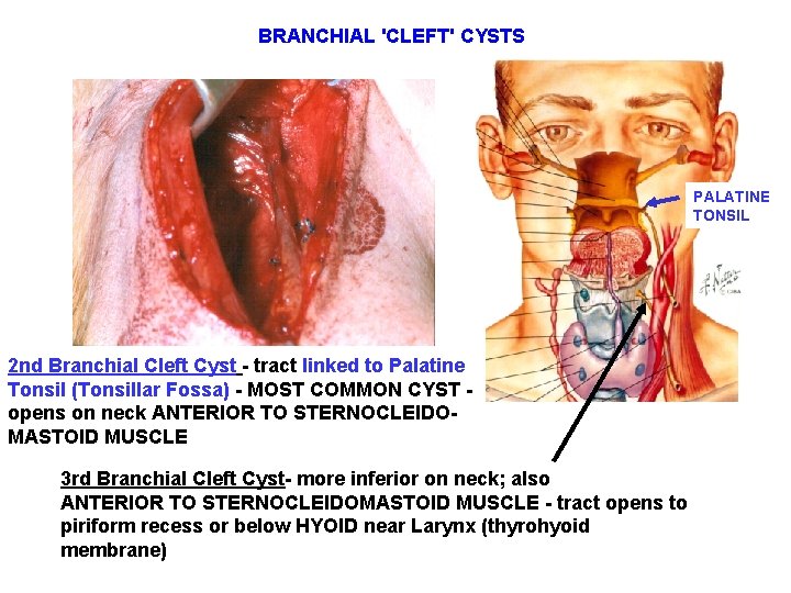 BRANCHIAL 'CLEFT' CYSTS PALATINE TONSIL 2 nd Branchial Cleft Cyst - tract linked to BRANCHIAL 'CLEFT' CYSTS PALATINE TONSIL 2 nd Branchial Cleft Cyst - tract linked to