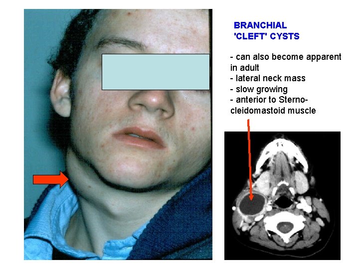 BRANCHIAL 'CLEFT' CYSTS - can also become apparent in adult - lateral neck mass
