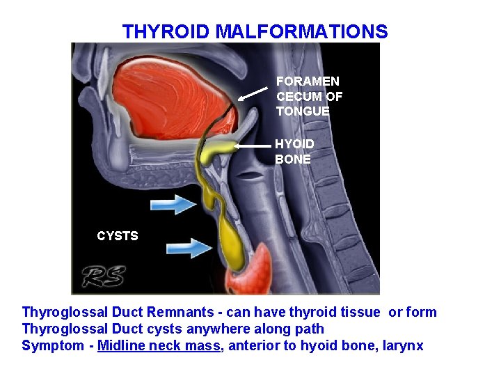 THYROID MALFORMATIONS FORAMEN CECUM OF TONGUE HYOID BONE CYSTS Thyroglossal Duct Remnants - can