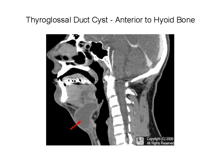 Thyroglossal Duct Cyst - Anterior to Hyoid Bone 