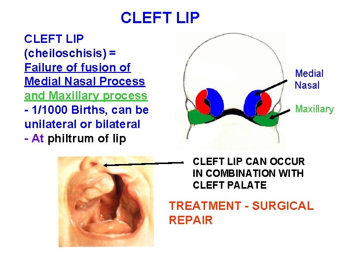 CLEFT LIP (cheiloschisis) = Failure of fusion of Medial Nasal Process and Maxillary process CLEFT LIP (cheiloschisis) = Failure of fusion of Medial Nasal Process and Maxillary process