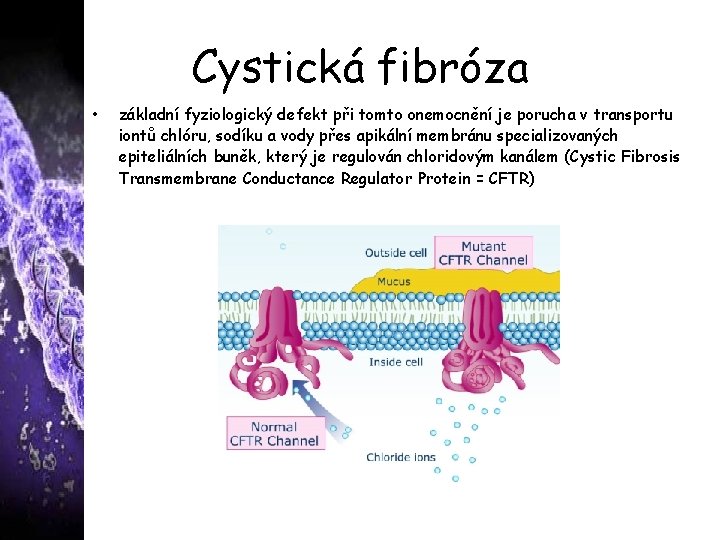 Cystická fibróza • základní fyziologický defekt při tomto onemocnění je porucha v transportu iontů