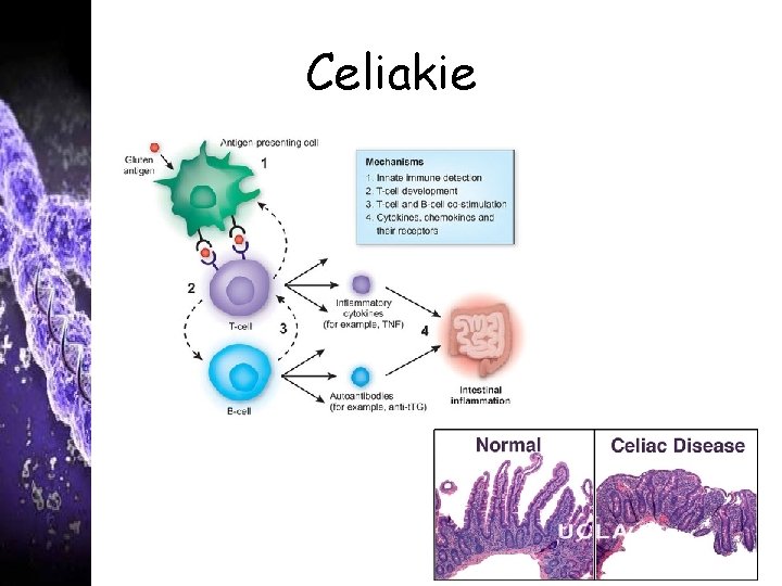 Celiakie 