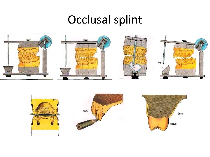 Occlusal splint 