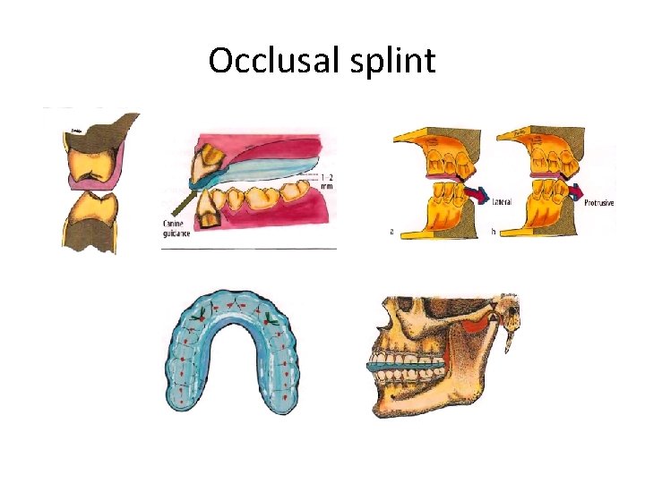 Occlusal splint 