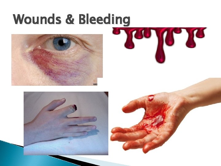 Wounds & Bleeding 