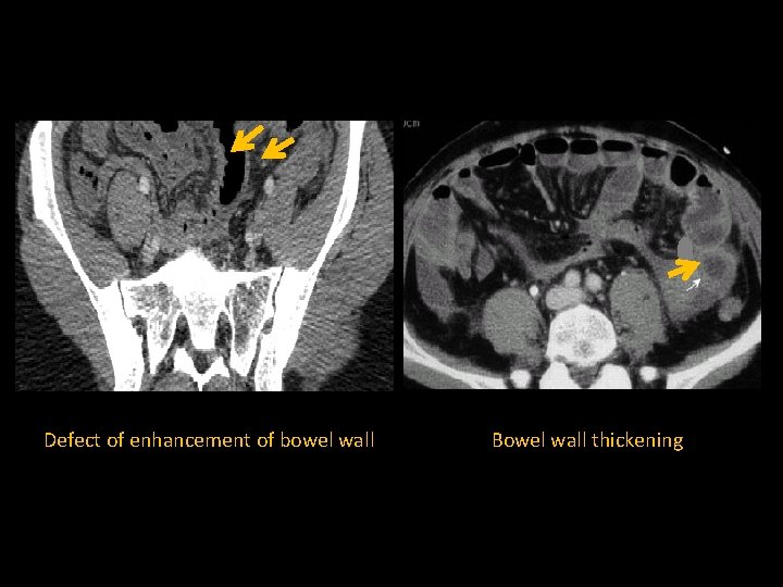 Defect of enhancement of bowel wall Bowel wall thickening 