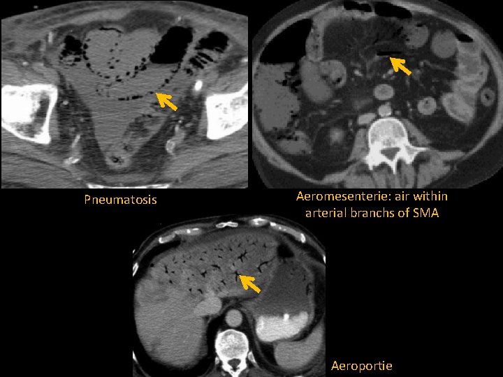 Pneumatosis Aeromesenterie: air within arterial branchs of SMA Aeroportie 