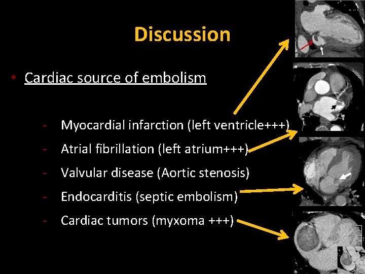 Discussion • Cardiac source of embolism - Myocardial infarction (left ventricle+++) - Atrial fibrillation