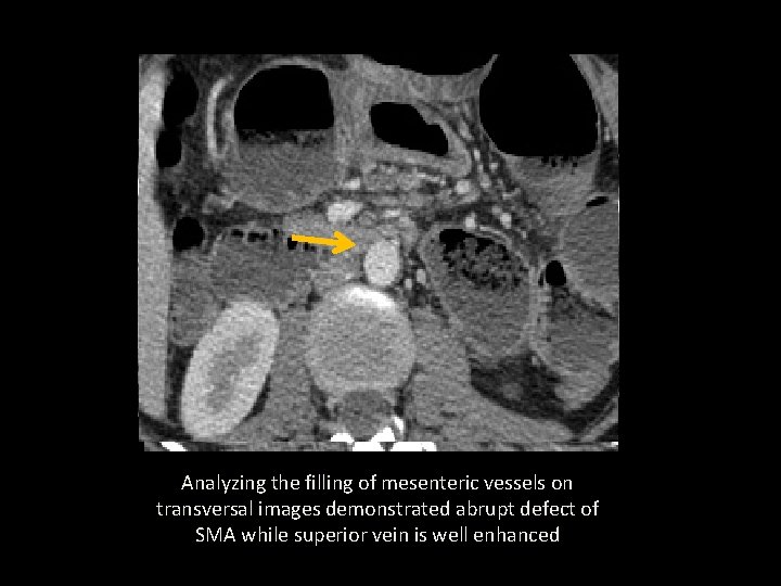 Analyzing the filling of mesenteric vessels on transversal images demonstrated abrupt defect of SMA