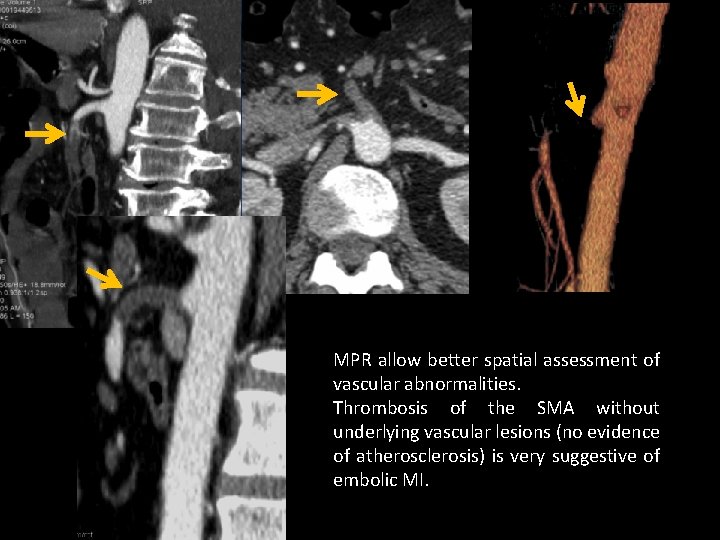 MPR allow better spatial assessment of vascular abnormalities. Thrombosis of the SMA without underlying
