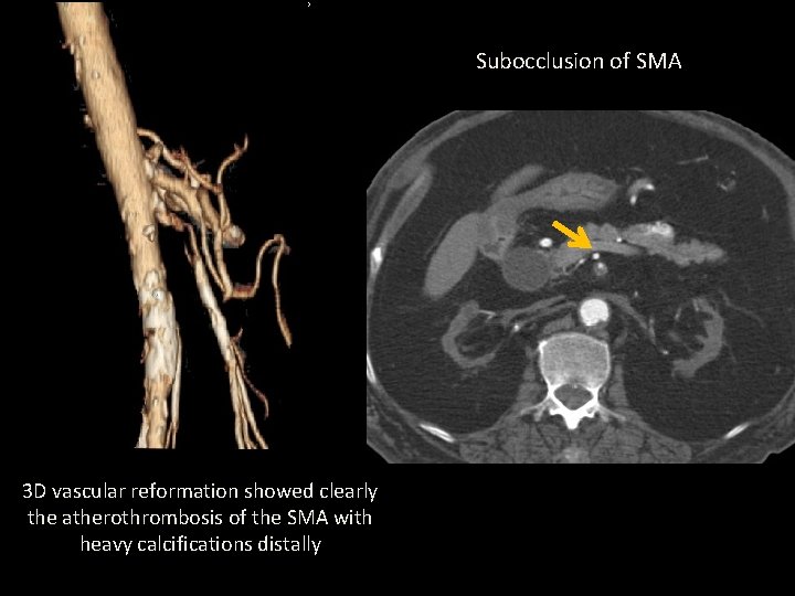Subocclusion of SMA 3 D vascular reformation showed clearly the atherothrombosis of the SMA