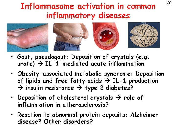 Inflammasome activation in common inflammatory diseases • Gout, pseudogout: Deposition of crystals (e. g.