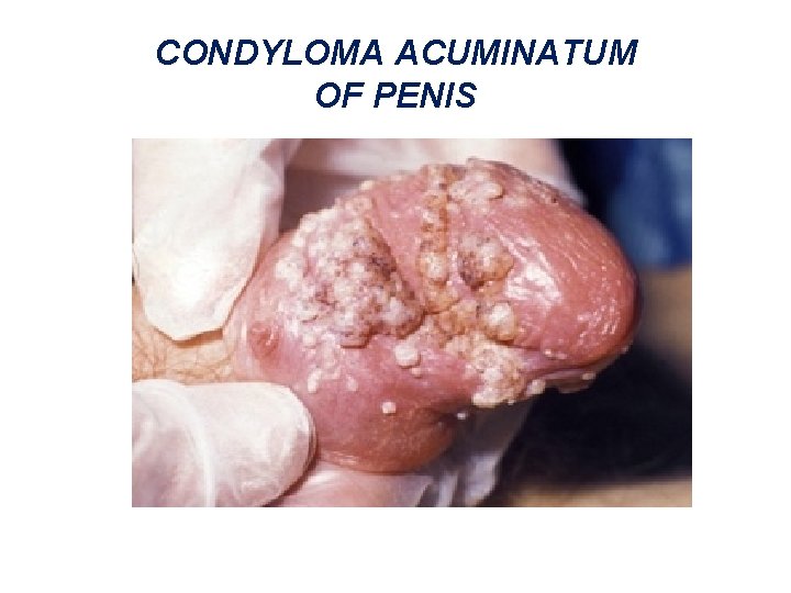 CONDYLOMA ACUMINATUM OF PENIS 