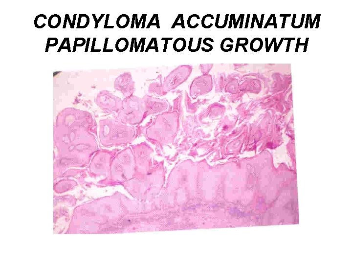 CONDYLOMA ACCUMINATUM PAPILLOMATOUS GROWTH 