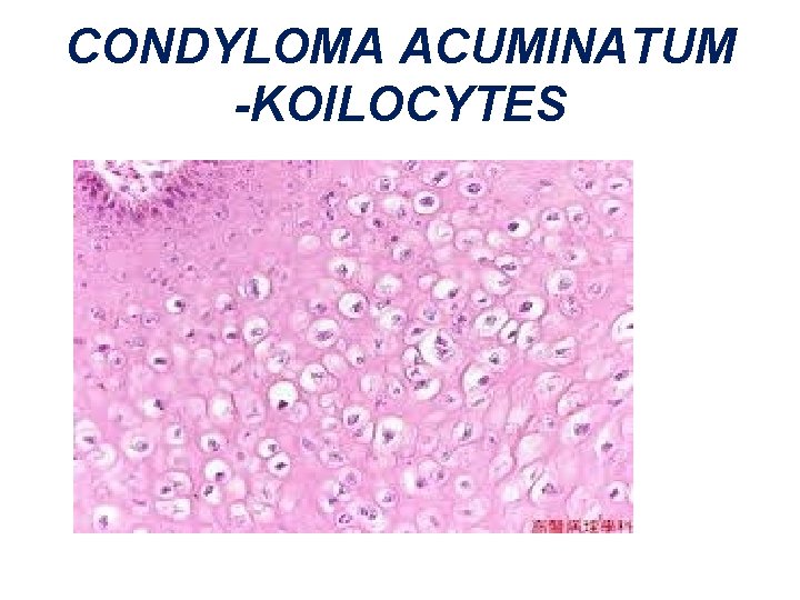 CONDYLOMA ACUMINATUM -KOILOCYTES 