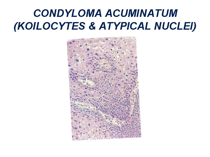 CONDYLOMA ACUMINATUM (KOILOCYTES & ATYPICAL NUCLEI) 