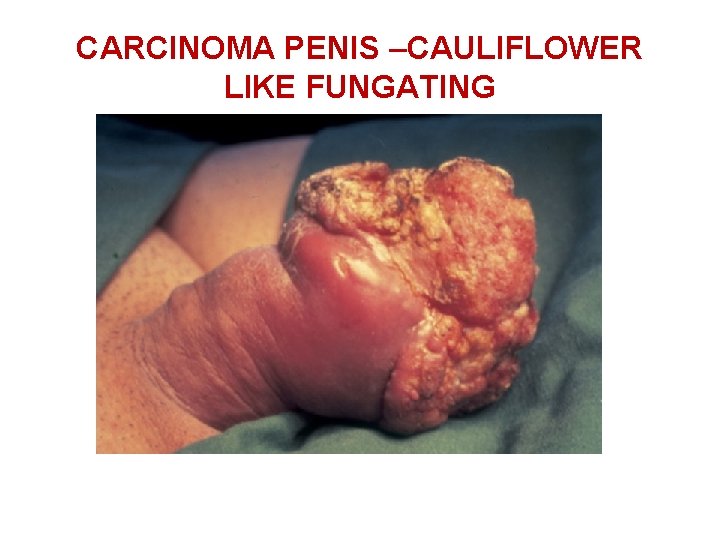 CARCINOMA PENIS –CAULIFLOWER LIKE FUNGATING 