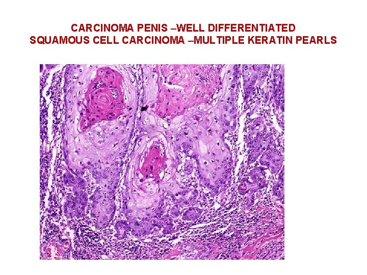 CARCINOMA PENIS –WELL DIFFERENTIATED SQUAMOUS CELL CARCINOMA –MULTIPLE KERATIN PEARLS 