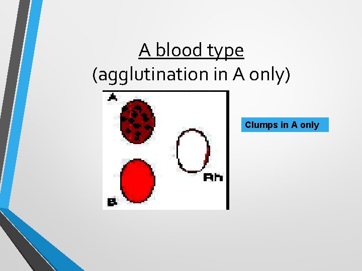 A blood type (agglutination in A only) Clumps in A only A blood type (agglutination in A only) Clumps in A only