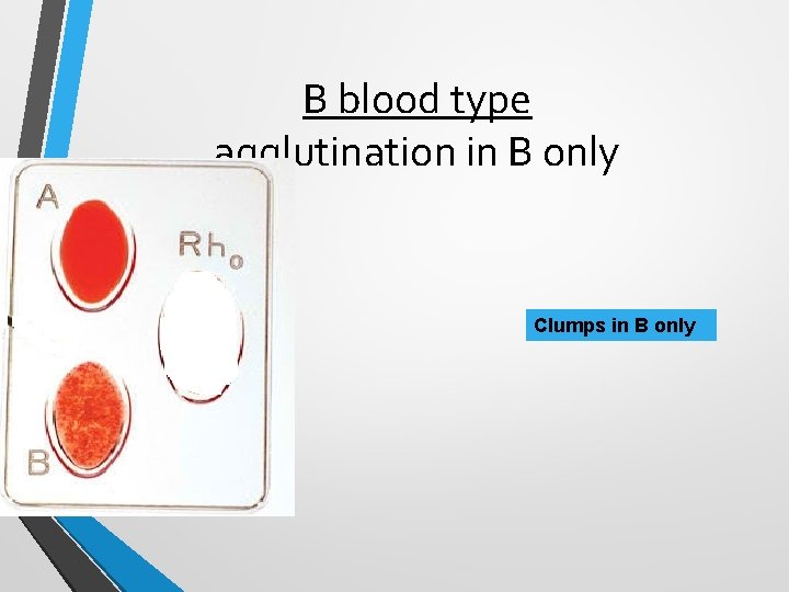B blood type agglutination in B only Clumps in B only B blood type agglutination in B only Clumps in B only