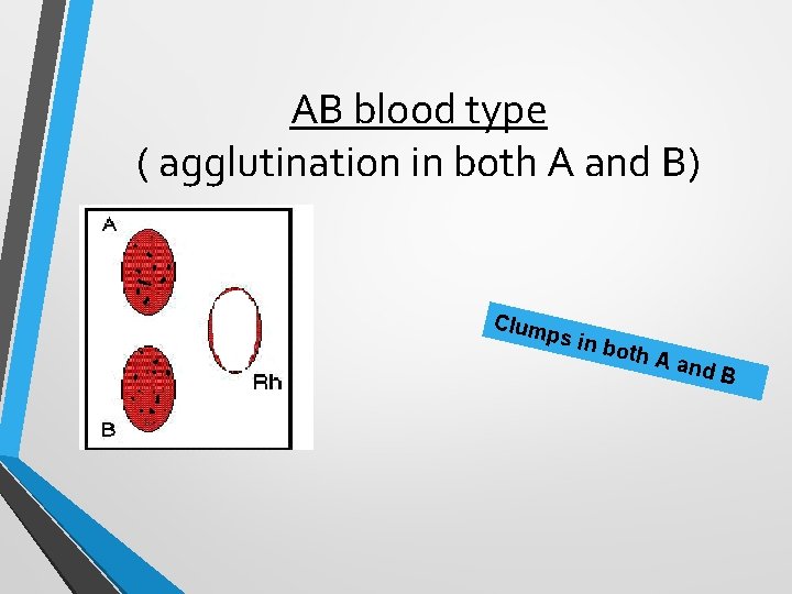 AB blood type ( agglutination in both A and B) Clum ps in both AB blood type ( agglutination in both A and B) Clum ps in both