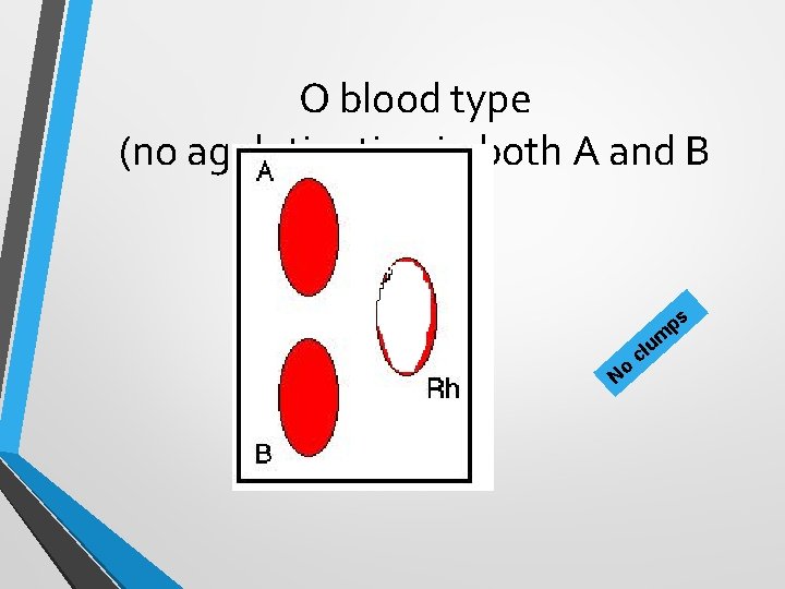 O blood type (no agglutination in both A and B o N u cl O blood type (no agglutination in both A and B o N u cl