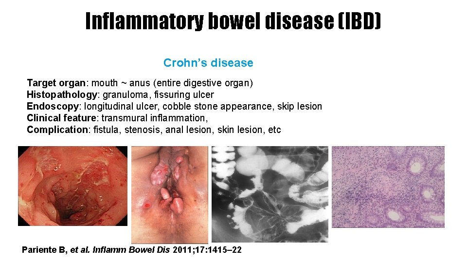 Inflammatory bowel disease (IBD) Crohn’s disease Target organ: mouth ~ anus (entire digestive organ)