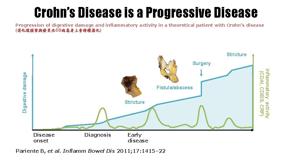 Crohn’s Disease is a Progressive Disease Progression of digestive damage and inflammatory activity in
