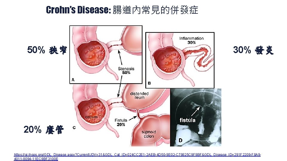 Crohn’s Disease: 腸道內常見的併發症 50% 狹窄 30% 發炎 20% 廔管 https: //gi. jhsps. org/GDL_Disease. aspx?