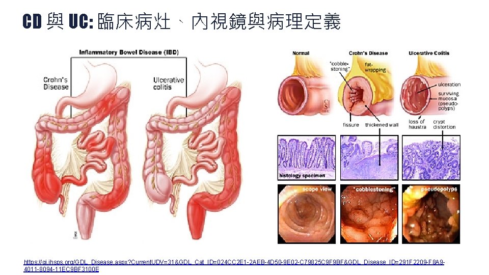 CD 與 UC: 臨床病灶、內視鏡與病理定義 https: //gi. jhsps. org/GDL_Disease. aspx? Current. UDV=31&GDL_Cat_ID=024 CC 2 E