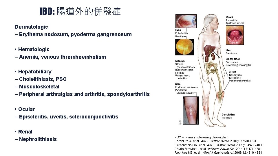 IBD: 腸道外的併發症 Dermatologic – Erythema nodosum, pyoderma gangrenosum • Hematologic – Anemia, venous thromboembolism