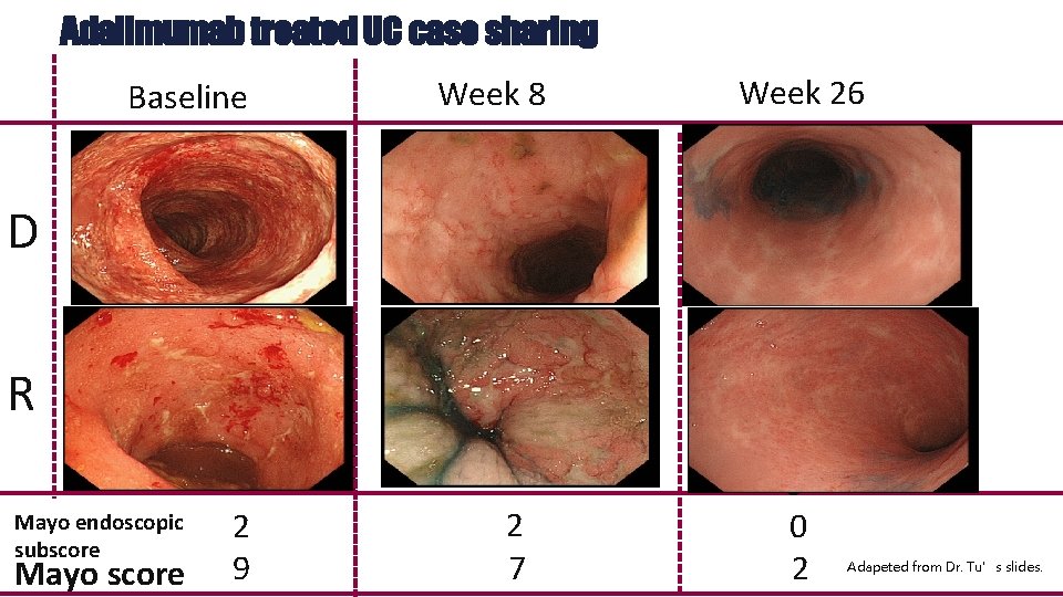 Adalimumab treated UC case sharing Baseline Week 8 Week 26 Week 8 D R