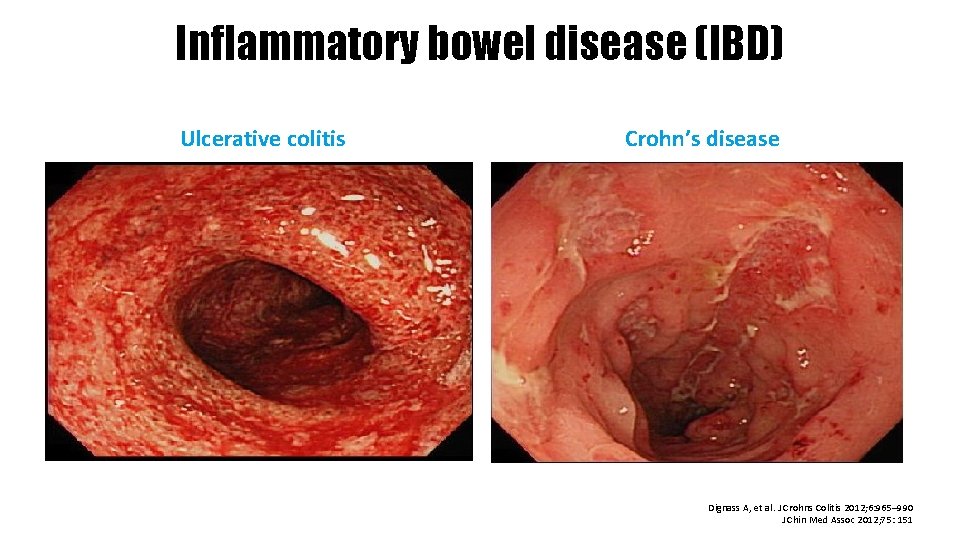 Inflammatory bowel disease (IBD) Ulcerative colitis Crohn’s disease Dignass A, et al. J Crohns