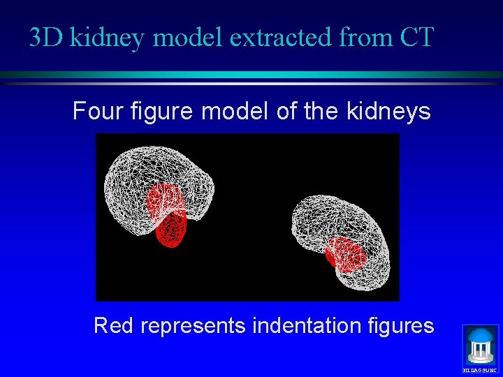 3 D kidney model extracted from CT Four figure model of the kidneys Red