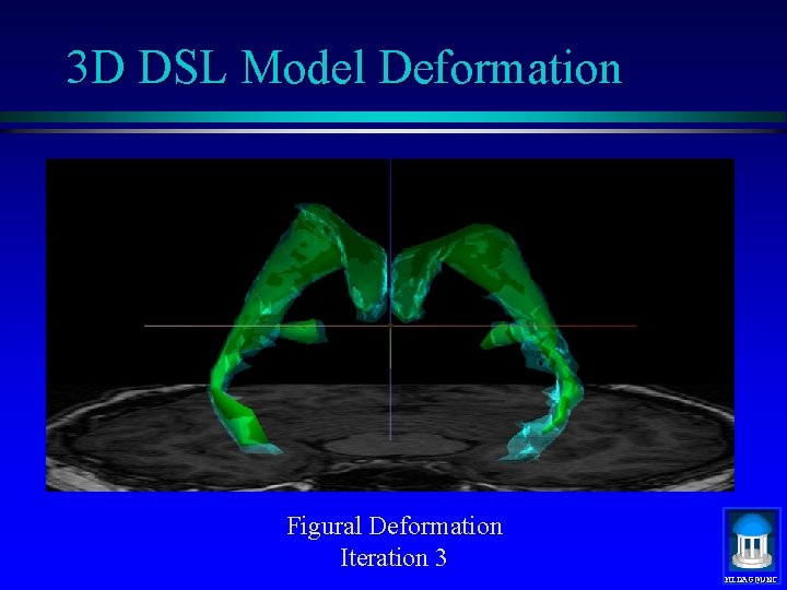 3 D DSL Model Deformation Figural Deformation Iteration 3 MIDAG@UNC 