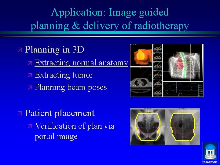 Application: Image guided planning & delivery of radiotherapy ä Planning in 3 D ä