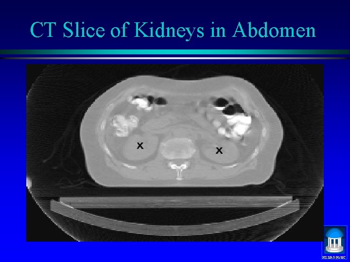 CT Slice of Kidneys in Abdomen MIDAG@UNC 