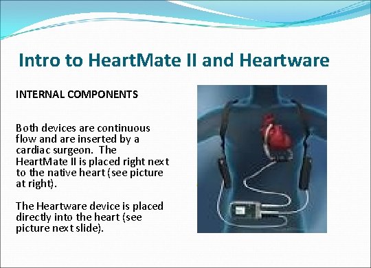 Intro to Heart. Mate II and Heartware INTERNAL COMPONENTS Implantable Pump Both devices are