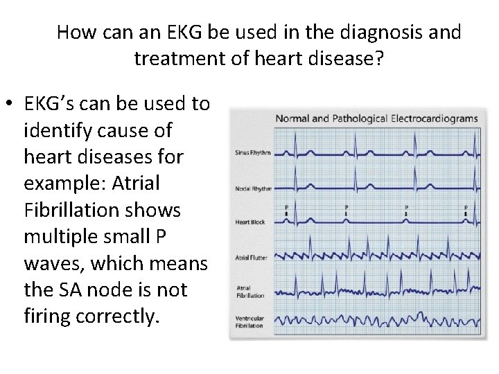 How can an EKG be used in the diagnosis and treatment of heart disease?
