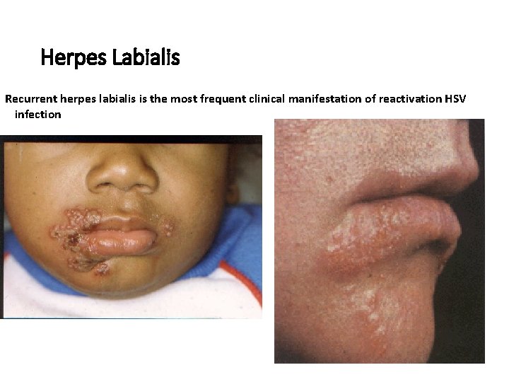 Herpes Labialis Recurrent herpes labialis is the most frequent clinical manifestation of reactivation HSV