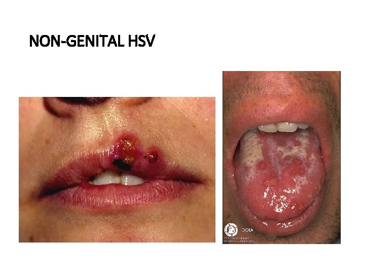 NON-GENITAL HSV 