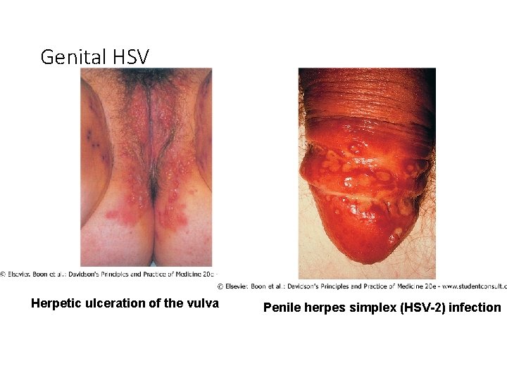 Genital HSV Herpetic ulceration of the vulva Penile herpes simplex (HSV-2) infection 